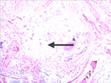 microscopic slide of onychomycosis